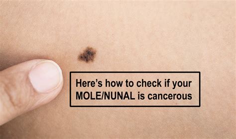 show me a picture of a mole|Skin Cancer Photos: What Skin Cancer & Precancerous ...